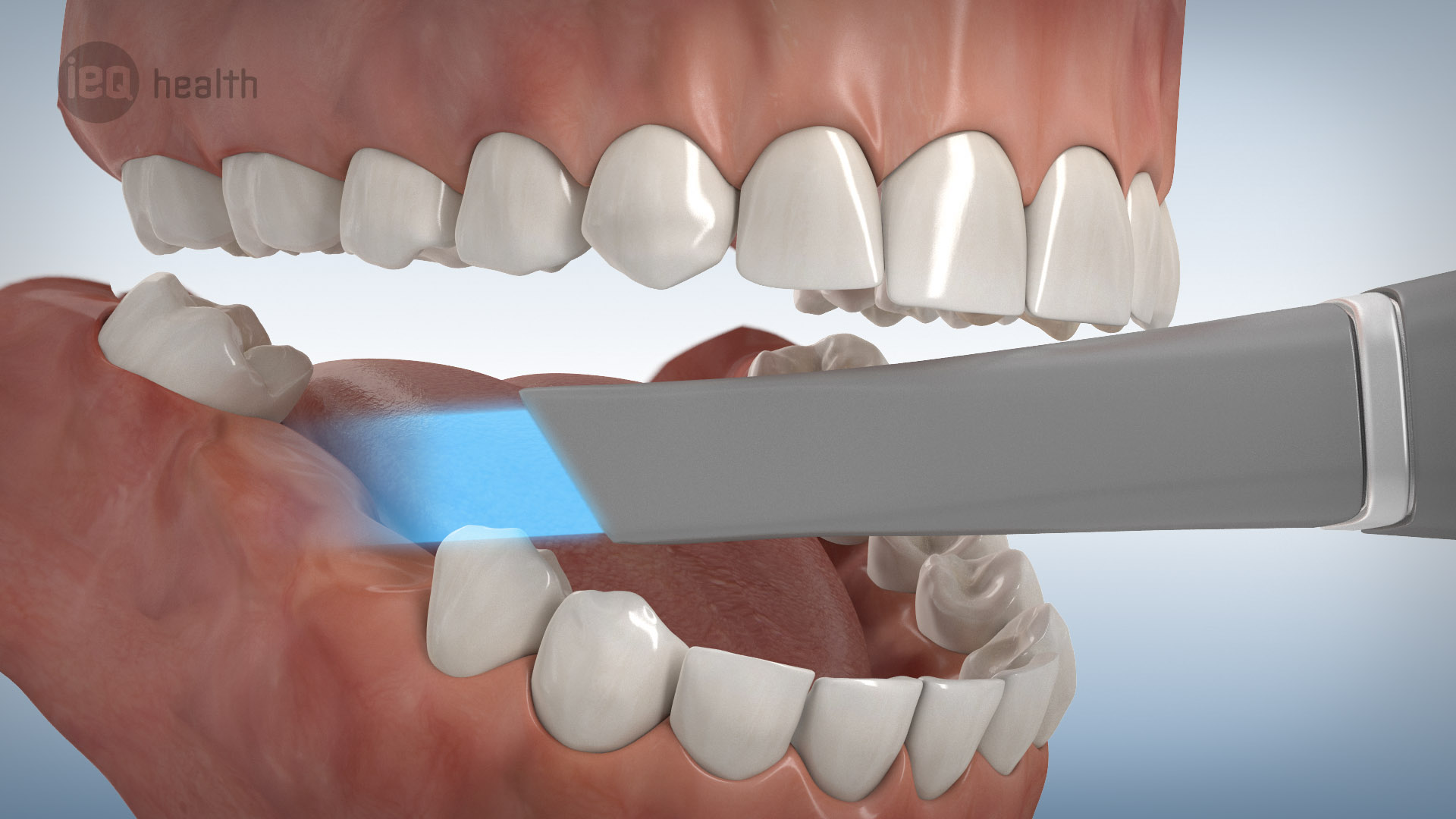 So Funktioniert Bleaching Video Zahnreinigung